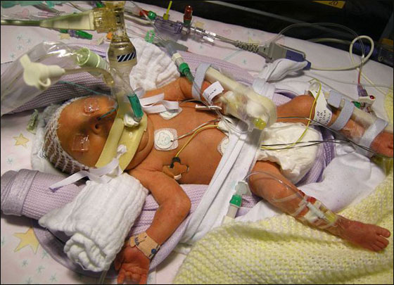 توأمان خديجان انقطع نفسهما خلال الولادة اكثر من 100 مرة! صورة رقم 3 توأمان خديجان انقطع نفسهما خلال الولادة اكثر من 100 مرة! صورة رقم 3