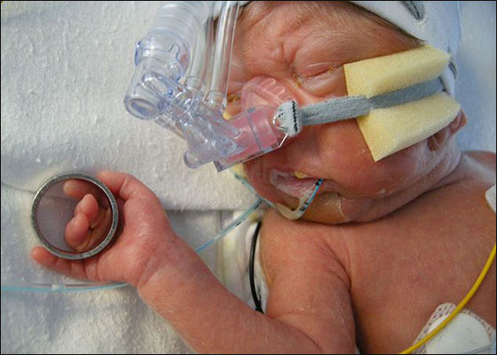 توأمان خديجان انقطع نفسهما خلال الولادة اكثر من 100 مرة! صورة رقم 4 توأمان خديجان انقطع نفسهما خلال الولادة اكثر من 100 مرة! صورة رقم 4