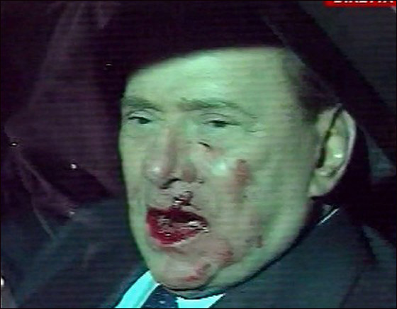 بعد الهجوم الاليم عليه.. برلسكوني يخضع لجراحة في عظام الفك  صورة رقم 2