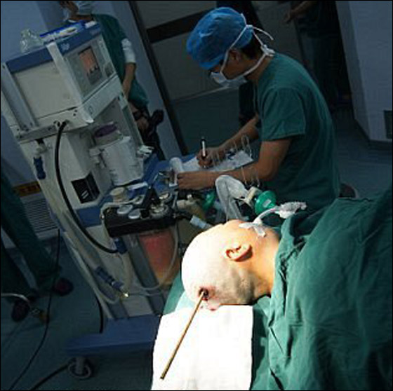 نجت باعجوبة بعدما اخترق سيخ دماغها إلى عمق 8 سنتيمترات صورة رقم 3 نجت باعجوبة بعدما اخترق سيخ دماغها إلى عمق 8 سنتيمترات صورة رقم 3