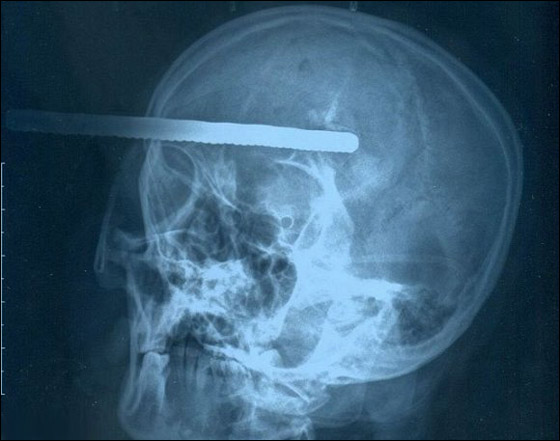 نجت باعجوبة بعدما اخترق سيخ دماغها إلى عمق 8 سنتيمترات صورة رقم 2 نجت باعجوبة بعدما اخترق سيخ دماغها إلى عمق 8 سنتيمترات صورة رقم 2