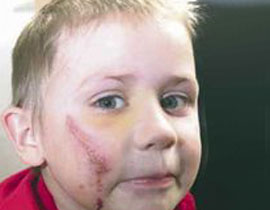 شاب يقذف حجرا من فوق الجسر ويصيب طفلا داخل سيارة بوجهه صورة رقم 1