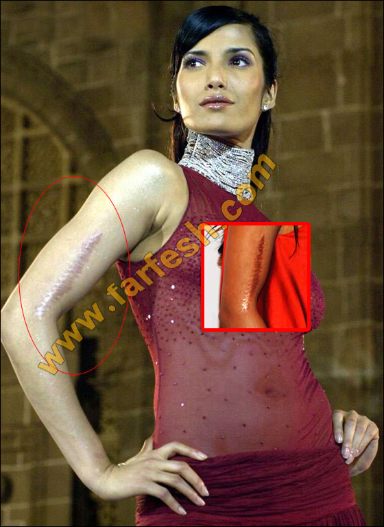 عيوب جسدية وتشوهات خلقية لدى النجمات العالميات الشهيرات! صورة رقم 10 عيوب جسدية وتشوهات خلقية لدى النجمات العالميات الشهيرات! صورة رقم 10