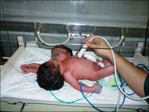 للمرة الاولى.. سيدة سورية تضع تواما ملتصقا سياميا!  صورة رقم 2