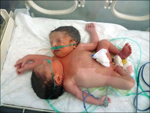 للمرة الاولى.. سيدة سورية تضع تواما ملتصقا سياميا!  صورة رقم 3