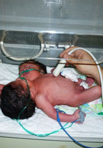 للمرة الاولى.. سيدة سورية تضع تواما ملتصقا سياميا!  صورة رقم 1