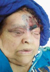 السعودية: اطباء يستأصلون عين مريضة قبل تشخيص حالتها الصحية! صورة رقم 1 السعودية: اطباء يستأصلون عين مريضة قبل تشخيص حالتها الصحية! صورة رقم 1