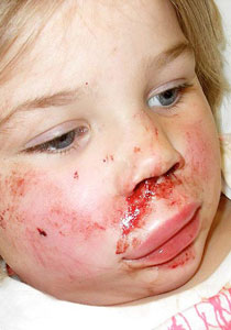 مراهق يهشم وجه طفلة بقطعة قرميد ألقاها على وجهها! صورة رقم 1 مراهق يهشم وجه طفلة بقطعة قرميد ألقاها على وجهها! صورة رقم 1