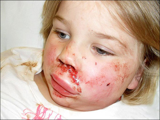 مراهق يهشم وجه طفلة بقطعة قرميد ألقاها على وجهها! صورة رقم 3 مراهق يهشم وجه طفلة بقطعة قرميد ألقاها على وجهها! صورة رقم 3