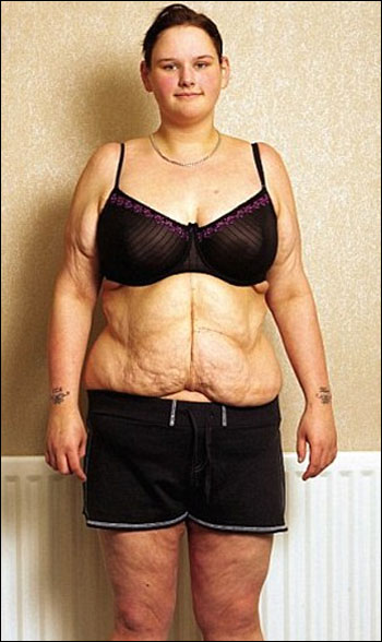 محزن: عملية تصغير المعدة تمنع فتاة من الاكل وتهدد حياتها!  صورة رقم 2