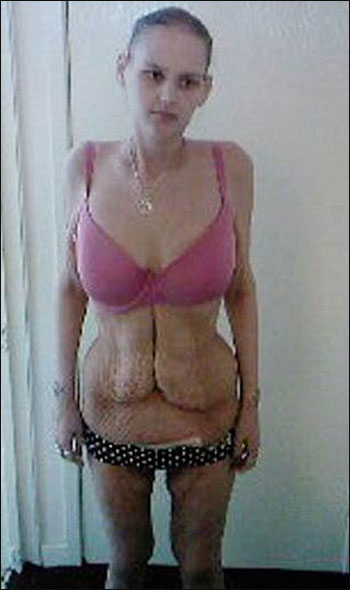 محزن: عملية تصغير المعدة تمنع فتاة من الاكل وتهدد حياتها!  صورة رقم 4