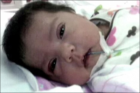 شفاء رضيعة من مرض خلقي نادر بعد عملية زراعة 7 اعضاء!!  صورة رقم 2