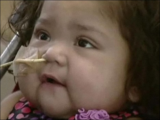 شفاء رضيعة من مرض خلقي نادر بعد عملية زراعة 7 اعضاء!!  صورة رقم 5