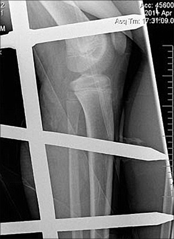 فتى ينجو باعجوبة بعدما بقي معلقا من رجله في قضبان حديدية صدئة!  صورة رقم 2