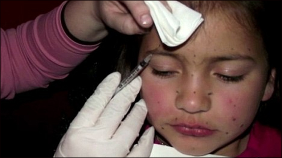 ما هو مصير الطفلة التي حقنتها والدتها بالبوتوكس؟! صورة رقم 3 ما هو مصير الطفلة التي حقنتها والدتها بالبوتوكس؟! صورة رقم 3