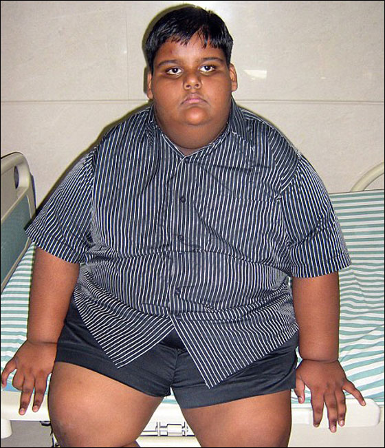 لاول مرة في التاريخ: طفل يخضع لعملية تصغير معدة بنجاح! صورة رقم 5 لاول مرة في التاريخ: طفل يخضع لعملية تصغير معدة بنجاح! صورة رقم 5