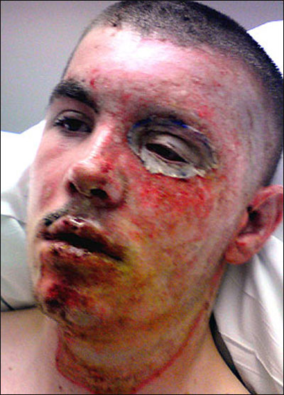 حاول سرقة سلك كهربائي فاحرق نفسه ونصح اصدقائه بعدم التقليد! صورة رقم 1 حاول سرقة سلك كهربائي فاحرق نفسه ونصح اصدقائه بعدم التقليد! صورة رقم 1