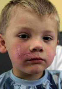 كلب يهاجم طفلا في الثالثة من عمره ويشوه وجهه!  صورة رقم 1