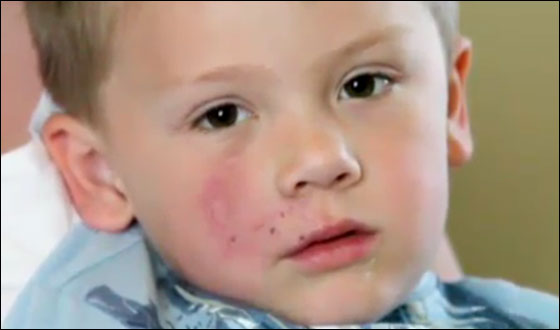 كلب يهاجم طفلا في الثالثة من عمره ويشوه وجهه!  صورة رقم 2