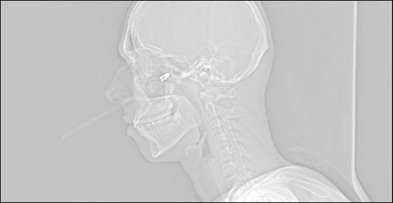 نجا باعجوبة بعد أن اخترق سهم خده الايمن بعمق 20 سم!!  صورة رقم 5