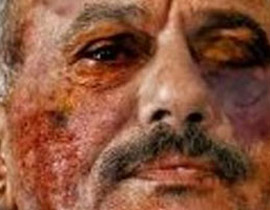 انتشار صورة للرئيس اليمني تظهر الحروق التي طالت وجهه! صورة رقم 1