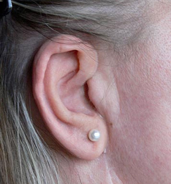 اعتادت على التسفع 15 ساعة يوميا.. فاصيبت بسرطان الاذن!! صورة رقم 4