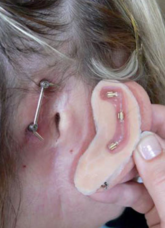 اعتادت على التسفع 15 ساعة يوميا.. فاصيبت بسرطان الاذن!! صورة رقم 3