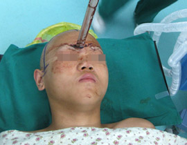 نجا باعجوبة بعد ان اخترق سيف جبينه على عمق 5 سم!!  صورة رقم 1