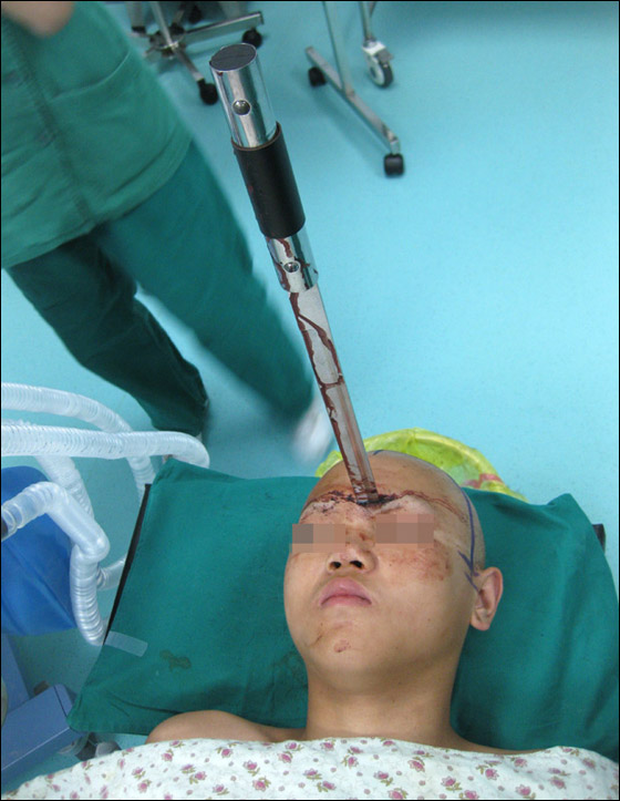 نجا باعجوبة بعد ان اخترق سيف جبينه على عمق 5 سم!!  صورة رقم 2