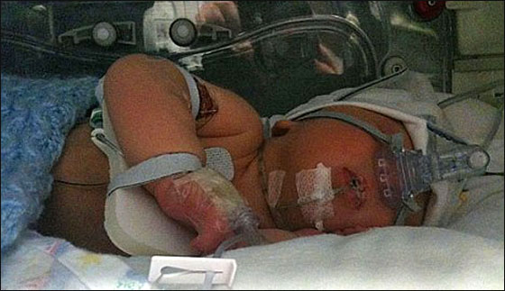 في حالة نادرة جدا: طفل بعمر الشهر يتغلب على السحايا 