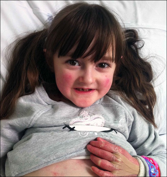 طفلة تحارب الموت يوميا وتعاني من مرض يقشر جلدها عند لمسه! صورة رقم 3