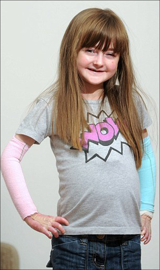 طفلة تحارب الموت يوميا وتعاني من مرض يقشر جلدها عند لمسه! صورة رقم 4