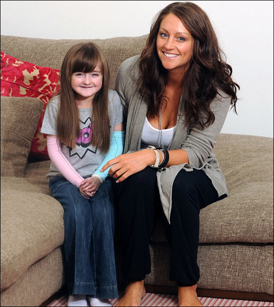 طفلة تحارب الموت يوميا وتعاني من مرض يقشر جلدها عند لمسه! صورة رقم 5