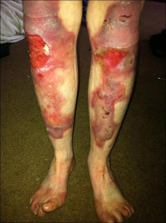 طفلة تحارب الموت يوميا وتعاني من مرض يقشر جلدها عند لمسه! صورة رقم 10