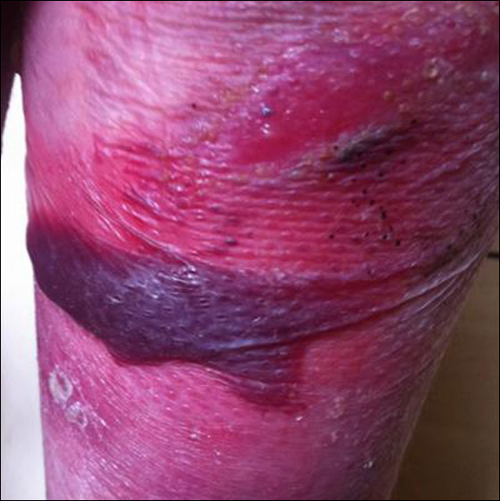 طفلة تحارب الموت يوميا وتعاني من مرض يقشر جلدها عند لمسه! صورة رقم 11