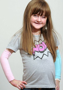 طفلة تحارب الموت يوميا وتعاني من مرض يقشر جلدها عند لمسه! صورة رقم 1