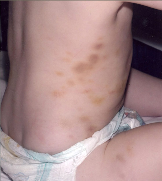  قاضٍ بريطاني يحرم أمًّا من الإنجاب بسبب تنكيلها بطفلتها!  صورة رقم 3