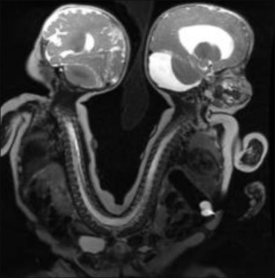 توأمان ملتصقان ينجوان بأعجوبة بعد عملية فصلهما!!  صورة رقم 1