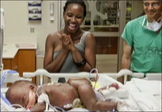 توأمان ملتصقان ينجوان بأعجوبة بعد عملية فصلهما!!  صورة رقم 3