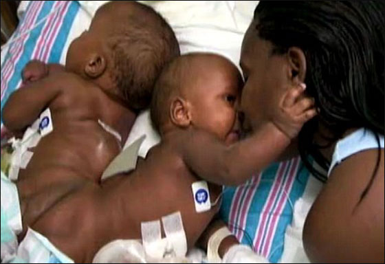 توأمان ملتصقان ينجوان بأعجوبة بعد عملية فصلهما!!  صورة رقم 2