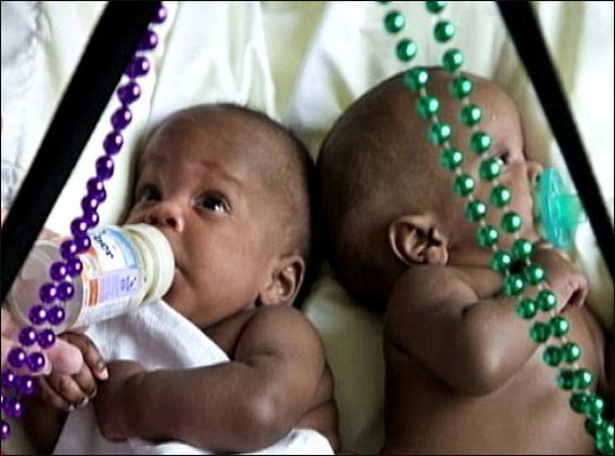 توأمان ملتصقان ينجوان بأعجوبة بعد عملية فصلهما!!  صورة رقم 10