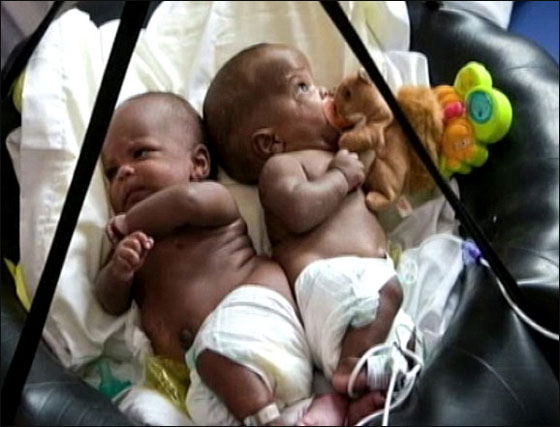 توأمان ملتصقان ينجوان بأعجوبة بعد عملية فصلهما!!  صورة رقم 9