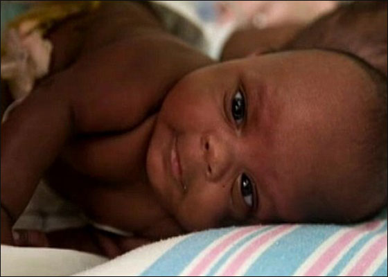 توأمان ملتصقان ينجوان بأعجوبة بعد عملية فصلهما!!  صورة رقم 5