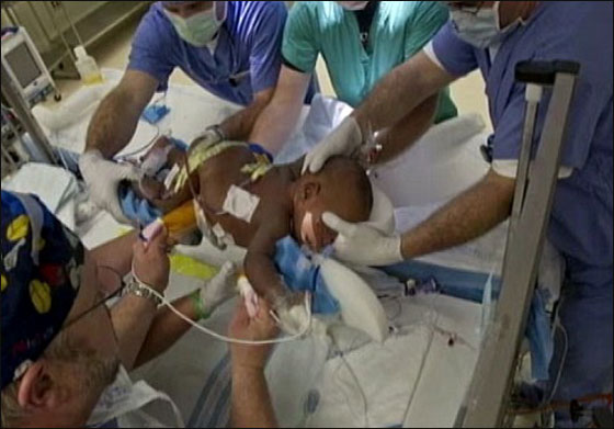 توأمان ملتصقان ينجوان بأعجوبة بعد عملية فصلهما!!  صورة رقم 6