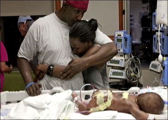 توأمان ملتصقان ينجوان بأعجوبة بعد عملية فصلهما!!  صورة رقم 8