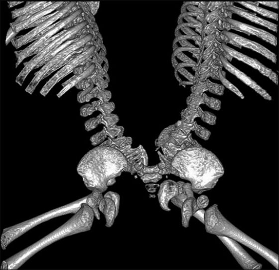 توأمان ملتصقان ينجوان بأعجوبة بعد عملية فصلهما!!  صورة رقم 7