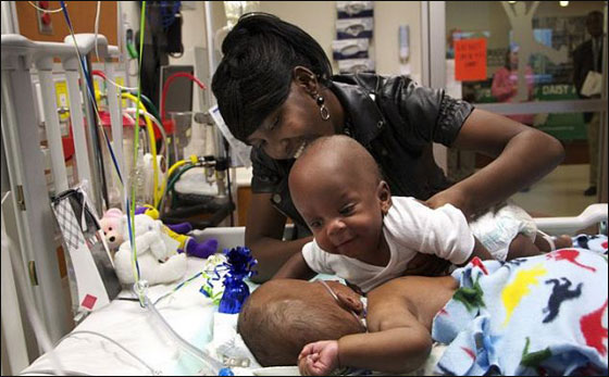 توأمان ملتصقان ينجوان بأعجوبة بعد عملية فصلهما!!  صورة رقم 11