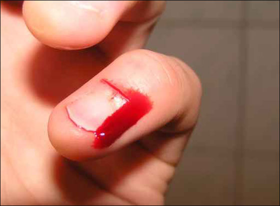 جرح اصبعه ووضعه في فم رجل.. فسجن 3 سنوات!! صورة رقم 1 جرح اصبعه ووضعه في فم رجل.. فسجن 3 سنوات!! صورة رقم 1