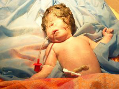 في حالة نادرة: عراقية تلد طفلا بعين واحدة وبدون انف!!  صورة رقم 2