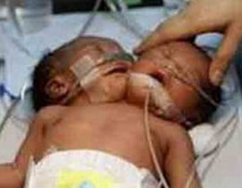 الجزائر: ولادة طفل برأٍسين و 4 ارجل! صورة رقم 1